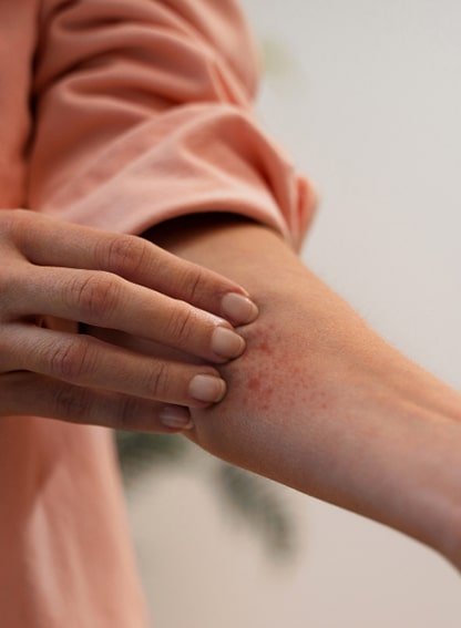 Picadura de la Oruga Procesionaria - Remi Hogar